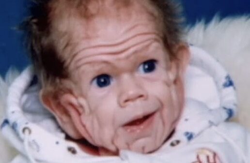 He Was Born with Extra Skin, But What He Looks Like Today Will Surprise You