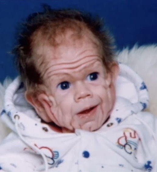 He Was Born with Extra Skin, But What He Looks Like Today Will Surprise You